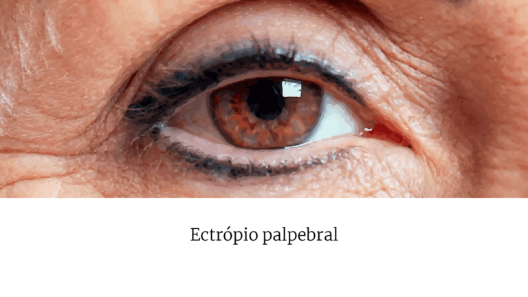 O ectrópio é um mau posicionamento palpebral caracterizado pela eversão da margem da pálpebra do globo ocular, o que pode acometer tanto a pálpebra superior quanto a inferior. A exposição crônica do globo e da conjuntiva palpebral resulta em sintomas de olho seco com lacrimejamento reflexo, irritação e desconforto ocular. A cirurgia é indicada para reposicionar a pálpebra, diminuindo os sintomas.
